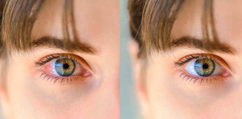 Blog dry eye